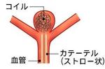 血管内手術（脳動脈コイル塞栓術）Intravascular operation (cerebral artery coil embolus [jutsu])